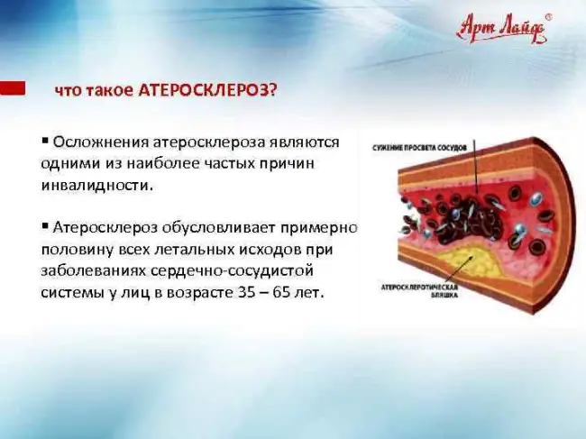 Причины атеросклероза