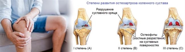 Лечение остеоартроза коленного сустава 